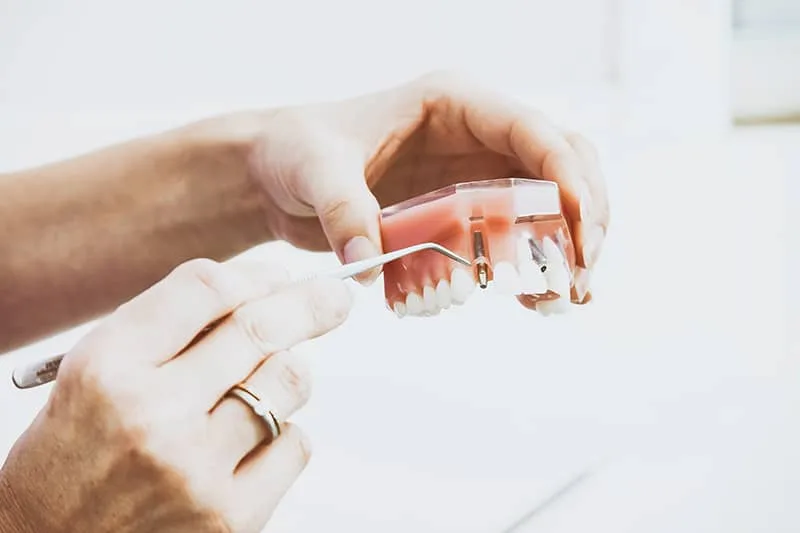 Dental Implants Patterson Lakes