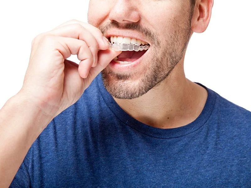 Invisalign vs Braces, Aesthetic Factor- Looks Better, Easily Removable, Comfortable to Wear